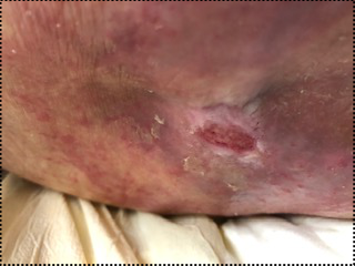 Clinical pressure-wound photograph, source figure 1