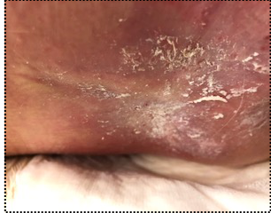 Clinical pressure-wound photograph, source figure 2