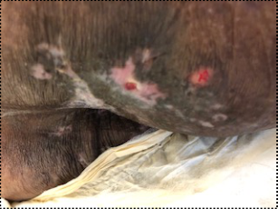 Clinical pressure-wound photograph, source figure 3