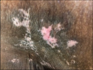Clinical pressure-wound photograph, source figure 4