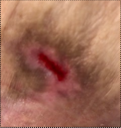Clinical pressure-wound photograph, source figure 5