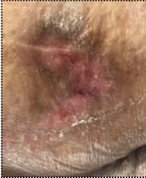 Clinical pressure-wound photograph, source figure 6